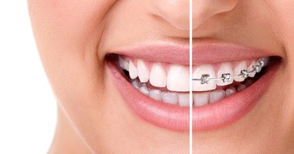 ortodonzia invisibie invisalign dentista milano San Gottardo ortodonzia invisibile invisalign dentista milano San Gottardo