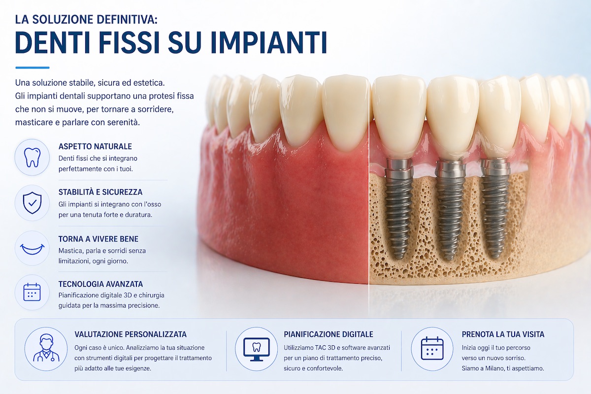 illustrazione di denti fissi supportati da impianti dentali sotto la gengiva