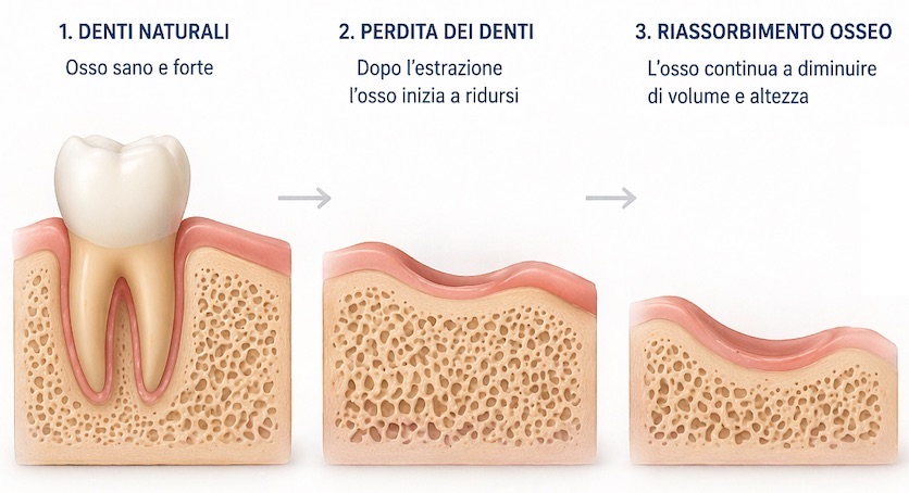 perdita di osso dopo la mancanza dei denti che rende difficile inserire impianti