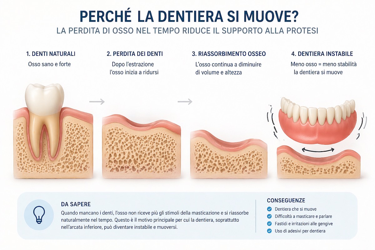 schema del riassorbimento osseo che causa instabilità della dentiera